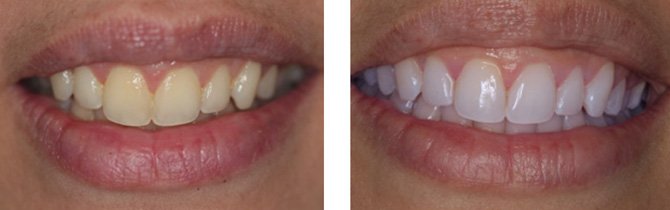GLO Whitening - Before & After | Gasser Dental