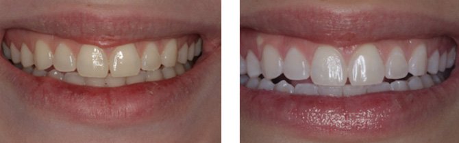 GLO Whitening - Before & After | Gasser Dental