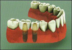 multiple_tooth_implant
