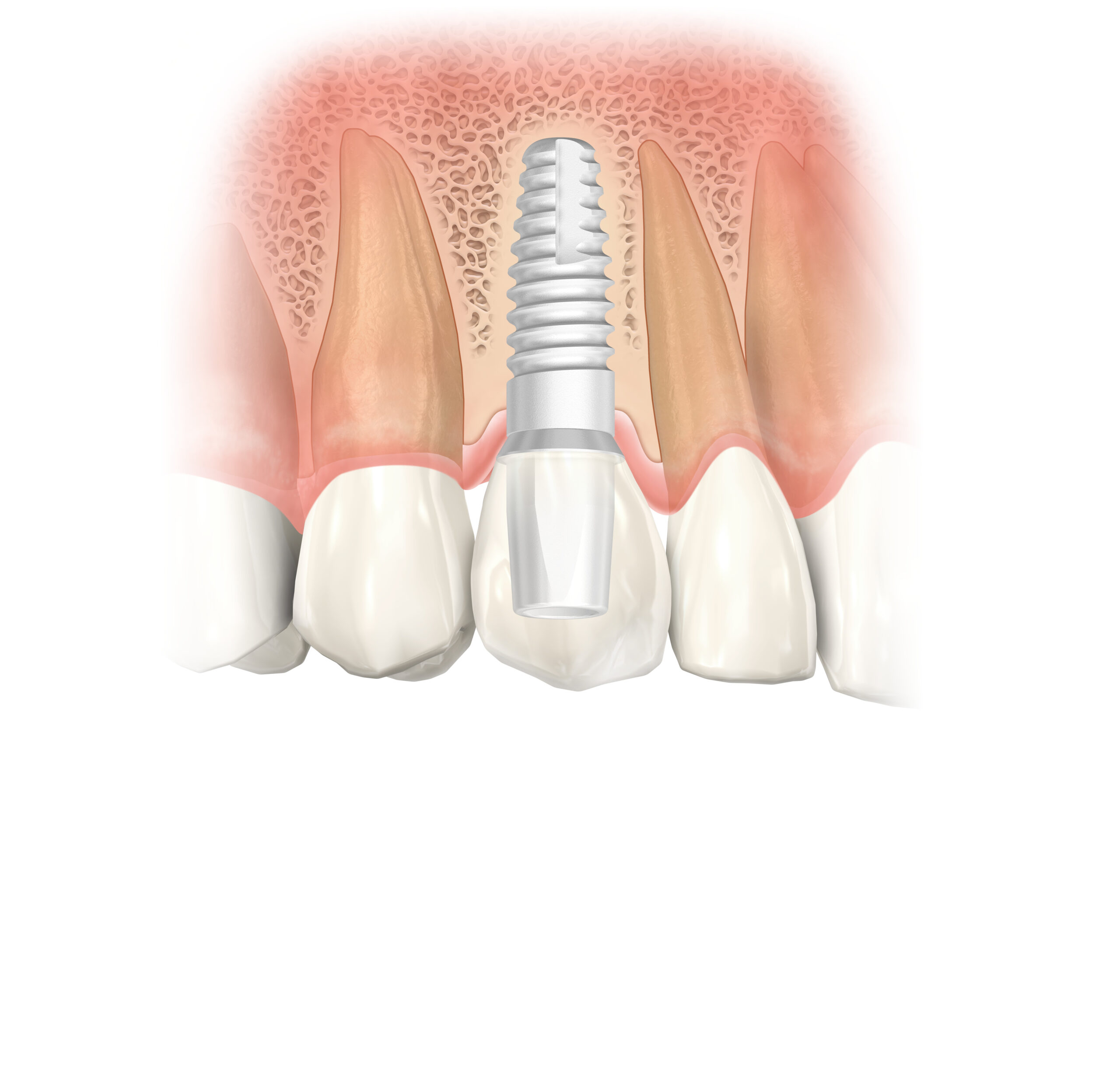 Ceramic/Non-Metal Implants - Sun City | Gasser Dental