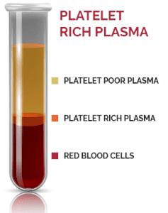 platelet-rich-plasma-diagr-upd-237x300